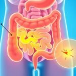 Illustration du syndrome de l'intestin irritable montrant l'abdomen avec des zones d'inflammation